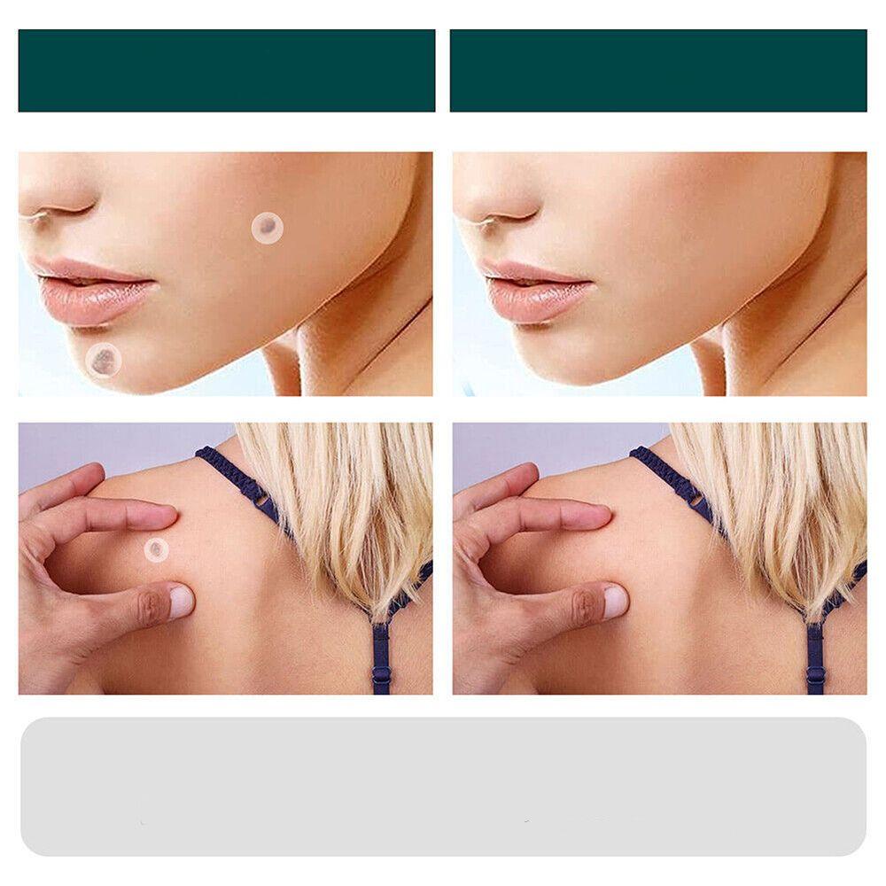 SkinClear - Patch for removing spots and warts