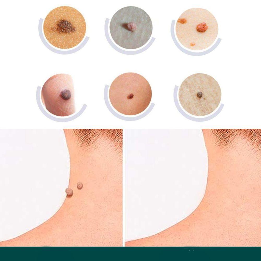 SkinClear - Patch for removing spots and warts